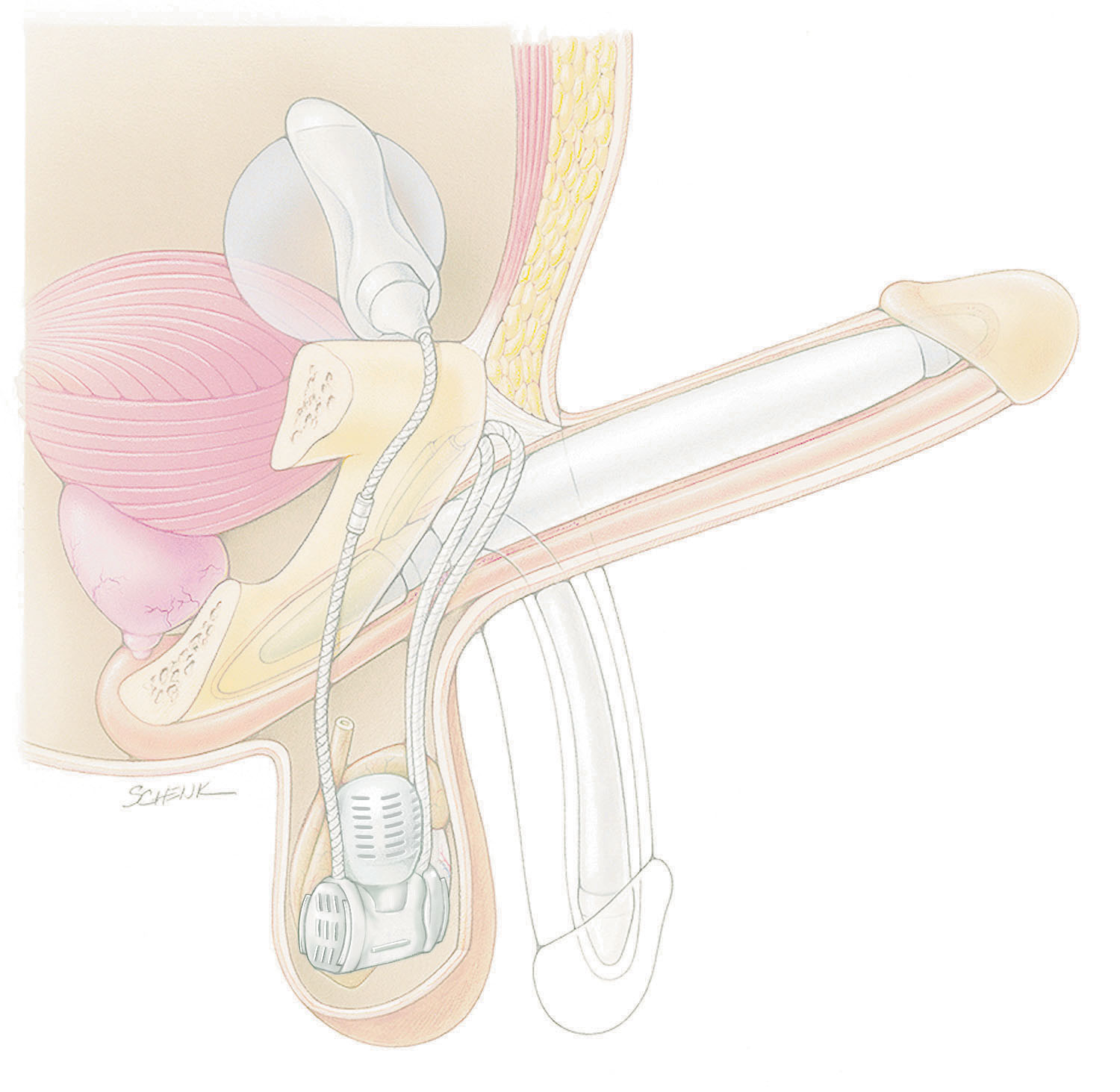 Other Types of Penile Implants by Dr. Garber